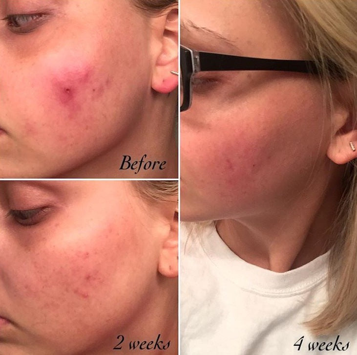 3-Step Oily OR Acne System