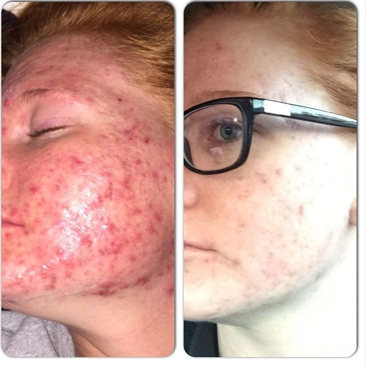 3-Step Oily OR Acne System