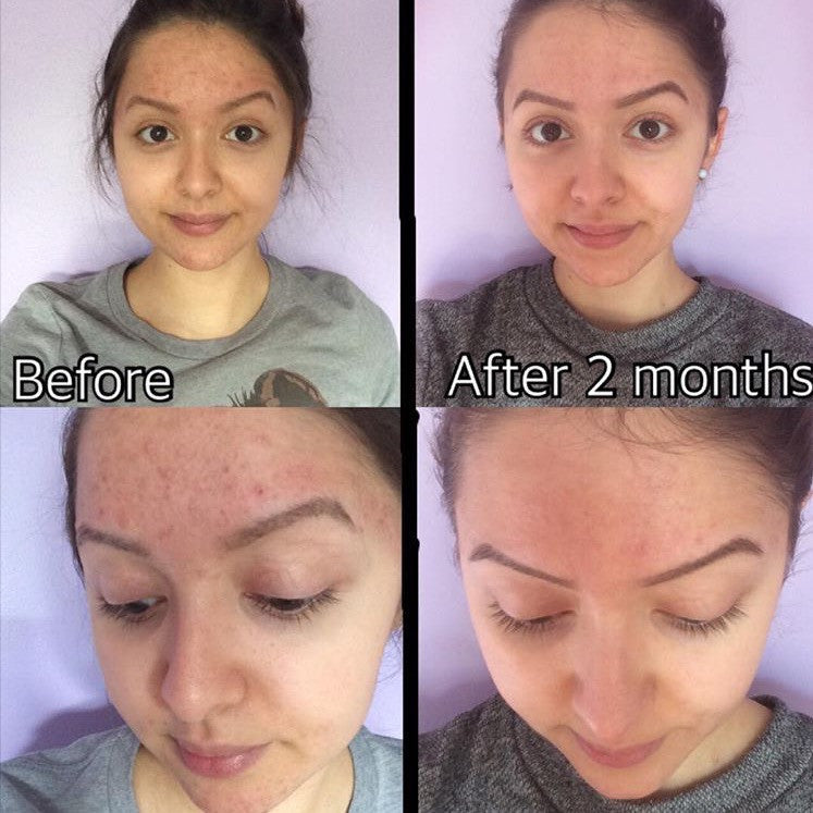 3-Step Oily OR Acne System