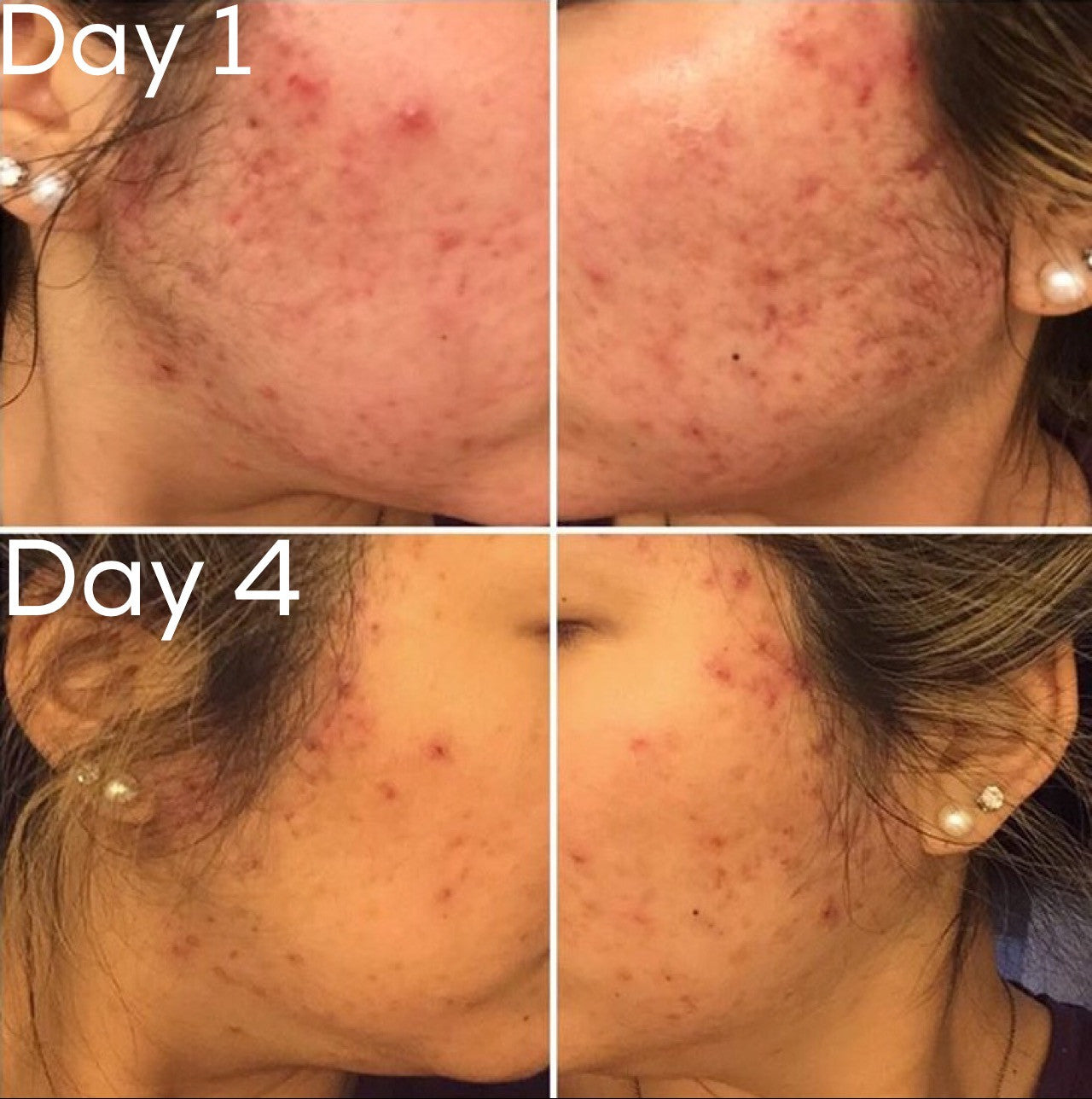 3-Step Oily OR Acne System