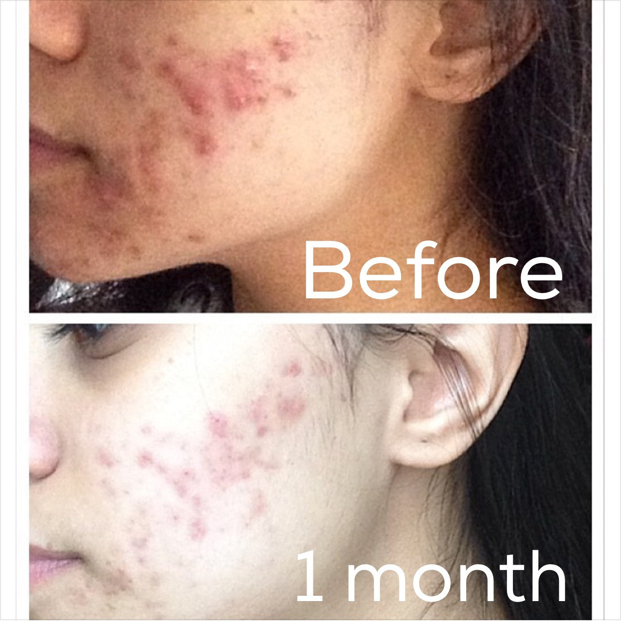 3-Step Oily OR Acne System